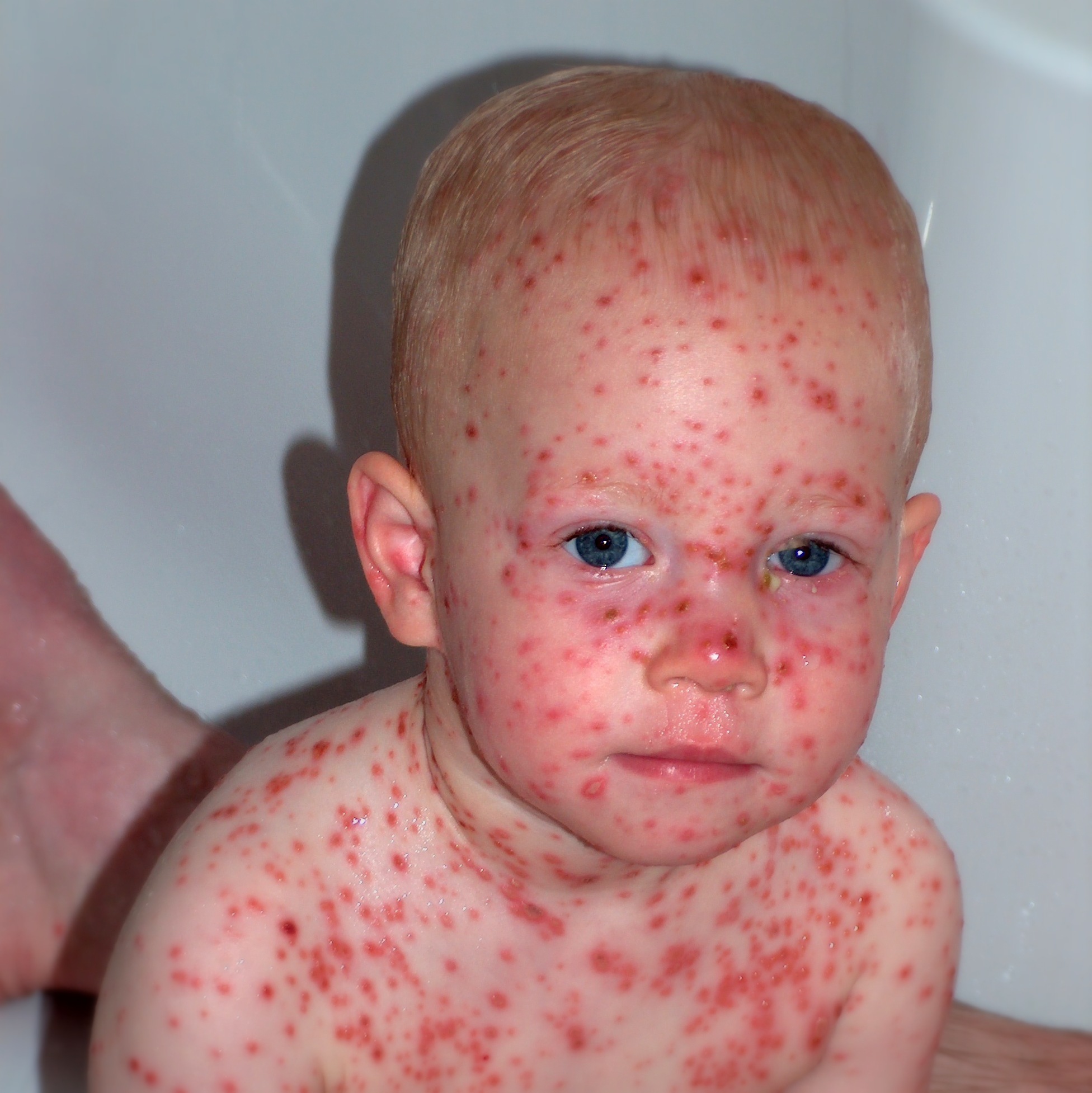 Varicella (chickenpox)