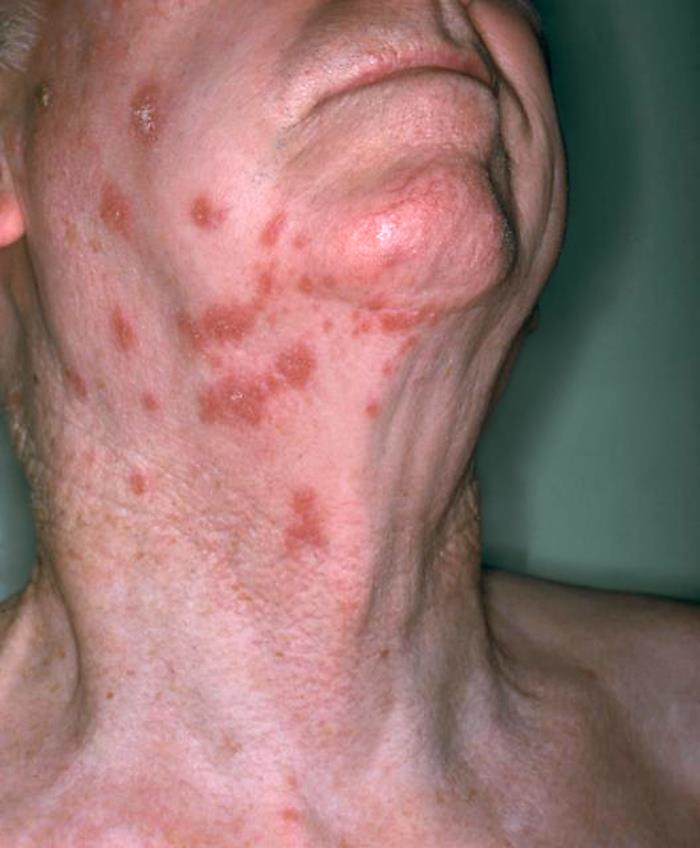 Herpes zoster (shingles)